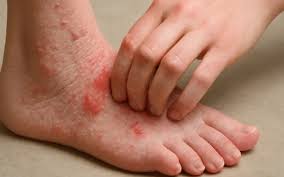 Image result for Neurodermatitis