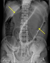 Image result for Volvulus