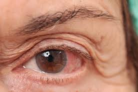 Important coronavirus updates for ophthalmologists (american academy of ophthalmology, san francisco, 2020). Coronavirus Stayed In Woman S Eyes For 20 Days