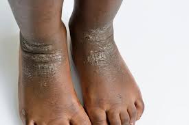 Image result for brown patches on the feet