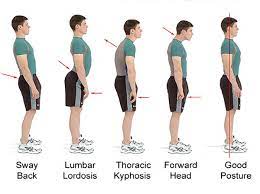 But do posture braces work? Is It Ok To Use Posture Brace For Correcting My Body Posture Quora