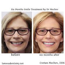 Six Month Smiles La Mesa 91942