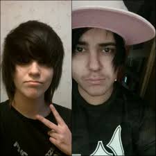 What to expect after bilateral above knee amputation fitting?