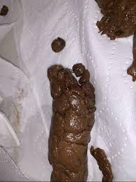 Image result for blood in stool human poop