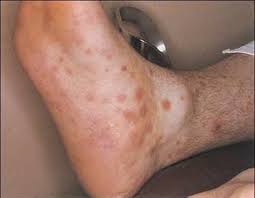 Image result for Primary Syphilis