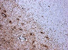 This damage disrupts the ability of parts of the nervous system to transmit signals , resulting in a range of signs and symptoms , including physical, mental , and sometimes psychiatric problems. Multiple Sclerosis Wikipedia