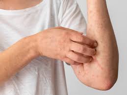 Image result for Atopic Dermatitis