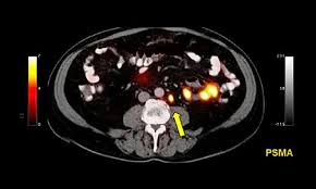 If breast cancer is diagnosed at an early enough stage, it's treatable. Psma Pet Ct Beats Standard Scan At Prostate Cancer Detecting Healthcare In Europe Com