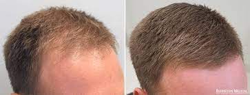 Sold under the brand names proscar™ and propecia™, finasteride is one of the most effective and highly advertised hair loss prevention remedies on the market. Propecia Rogaine Before After Photos Bernstein Medical