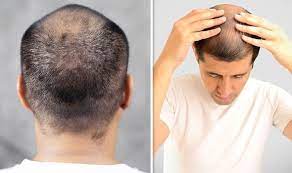 While scalp massagers can help increase blood flow—which. Hair Loss Treatment Hair Loss Treatment A Four Minute Scalp Massage Daily Could Promote Express Co Uk