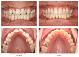 A good orthodontist will examine your case and provide you with treatment options which would be. Before And After Photos Florman Orthodontics
