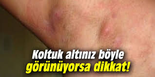 Koltuk Alty Kyl Domesi Belirtileri