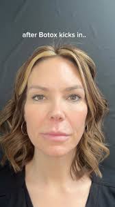 Before & After Botox ✨, Enjoy a smoother, refreshed you in just minutes  while helping combat pre mature aging. Results can take up to 2 weeks to  fully set in, with effects lasting up to 3-4 months. , ...