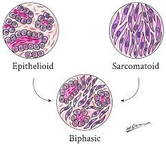 Epithelioid mesothelioma may grow slower and chemotherapy often works better for this type. Mesothelioma Mypathologyreport Ca