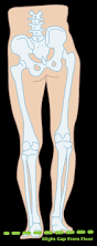 Image result for Functional Leg Length Discrepancy