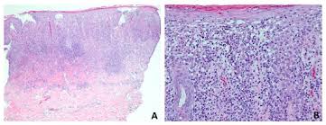 Image result for penis mycosis symptoms