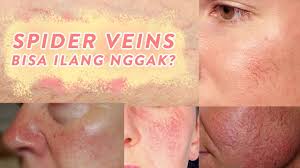 Apabila masalah seperti ini anda biarkan begitu saja, maka akan meningkatkan risiko buta permanen. Cara Menghilangkan Urat Halus Di Wajah Skincare 101 Youtube