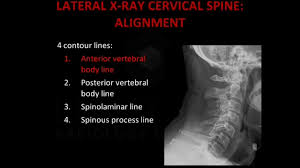 Welcome to the world of picture frames! Emergency X Ray Interpretation Part 2 Cervical Spine Alexander Street A Proquest Company