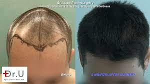Some patients observe patchy hair loss in areas that were not transplanted. Video Hair Loss After Hair Transplant At 26 In A Happy Patient