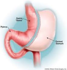 Sleeve Sleeve Surgery Gastric Sleeve Surgery Gastric Sleeve