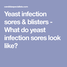 Yeast Infection Sores Blisters What Do Yeast Infection Sores Look Like Yeast Infection Yeast Infection Causes Infections