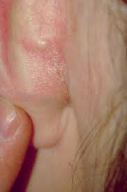Luckily, there are effective medicines over the counter. 6 Retroauricular Intertrigo 20 Year Old Man Download Scientific Diagram