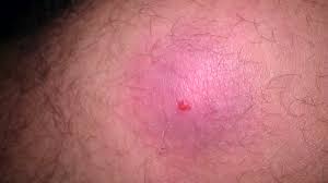 Staph can become resistant to antibiotics, called methicillin resistant staphylococcus aureus or mrsa. How To Recognize Mrsa Symptoms