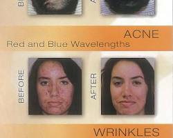 Image of Red and nearinfrared light therapy for hair loss: A review