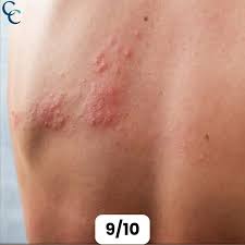 Image result for genital herpes