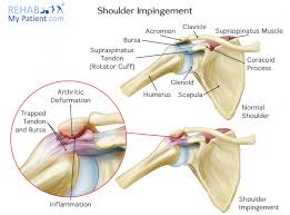 Shoulder Impingement Syndrome Rehab My Patient