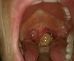 Most throat cancer symptoms aren't specific to cancer, so your doctor will likely investigate other more common causes first. Throat Cancer Pictures Survival Rate Symptoms Causes Treatment Hubpages