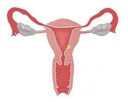 Other, rarer uterine cancers, called uterine sarcomas, develop from underlying muscle or connective tissue. Uterine Cancer Treatment Hospital In Ahmedabad Gujarat