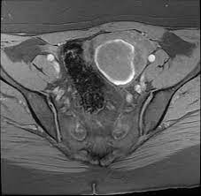They are readily diagnosed on ultrasound, with most demonstrating classical radiographic features. Endometriosis Radiology Reference Article Radiopaedia Org