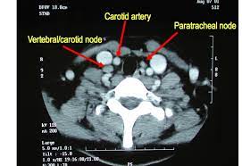 It contains information about head and neck cancer, life as a laryngectomee, and manuscripts and videos about dr. Diagnosis Of Papillary Thyroid Cancer