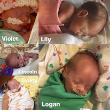 Quituplets Born In 60 Seconds Unique Pregnancy