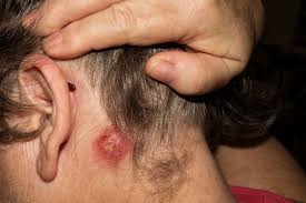While many cases of scalp mrsa produce no symptoms other than skin lesions, some people experience staph infection symptoms throughout the whole body. How Why Staph Infections Can Cause Joint Pain Jointflex
