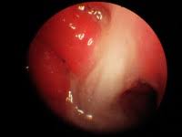 Maybe you would like to learn more about one of these? Rhino Sinusitis Ent Kent