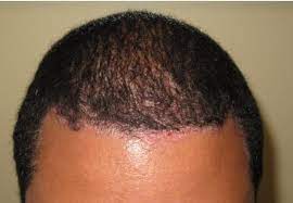 How to spot scalp psoriasis. What Is Scalp Psoriasis National Psoriasis Foundation