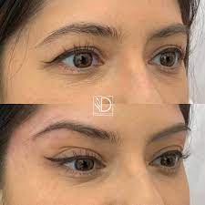 It is performed without surgery and takes up to 30 minutes. Foxy Eyes The Trend Without Surgery Derma Clinic Spain