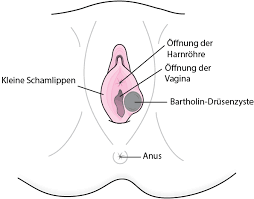 Zum beispiel der mangel an östrogen (oft in der menopause auftritt) provoziert die übermäßige trockenheit der haut, was in der bildung und mikrotraumata. Bartholin Zysten Gesundheitsprobleme Von Frauen Msd Manual Ausgabe Fur Patienten