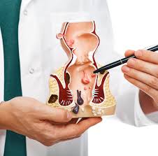 If you've had a caesarean, see recovering from a caesarean. Piles Haemorrhoids Cost Treatment Surgery Kam Colorectal