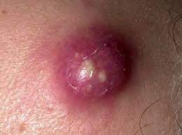 Furunculos E Antraz Disturbios Dermatologicos Manuais Msd Edicao Para Profissionais