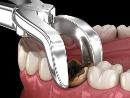 It can stop a few minutes after the surgery and then start bleeding again a few hours later. Wisdom Teeth Removal Cost Omega Dental Houston Tx