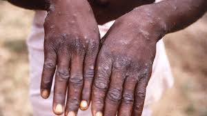 Health Ministry releases guidelines for management of Monkeypox | Today News