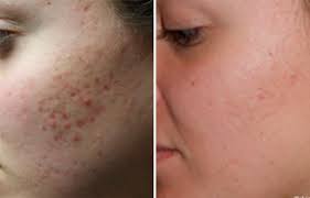 | meaning, pronunciation, translations and examples. Common Acne Scars And How To Get Rid Of Them The Healthy