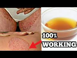 Fungal Infection Treatment Ringworm Treatment With Apple Cider Vinegar 100 Natural Home Remedy Youtube