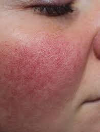 Couperose Rosacea I Rotungen Reduzieren Richtig Ernahren