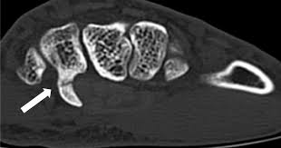 Image result for Hamate Bone