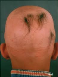 Vitiligo in individuals with darker skin is more noticeable; Alopecia Areata Glen Rock Nj Dermatologist
