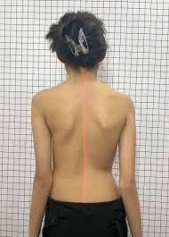 اعوجاج العمود الفقري مجهول السبب عند المراهقين